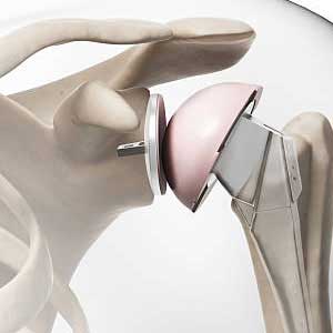 shoulder replacement in vijayawada