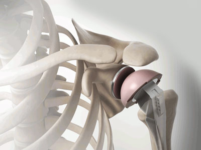 shoulder replacement surgery